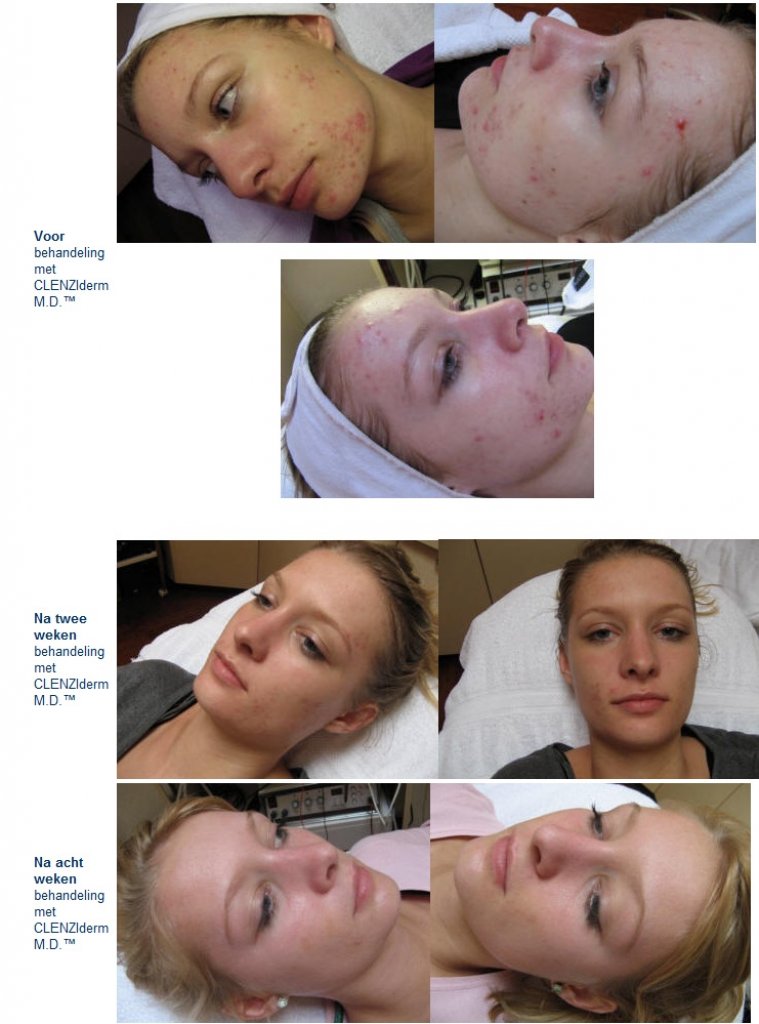 Acne behandelingen