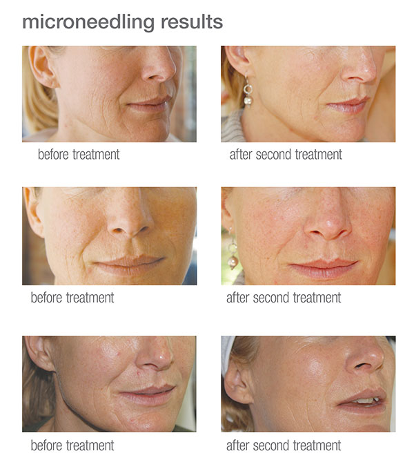 microneedling