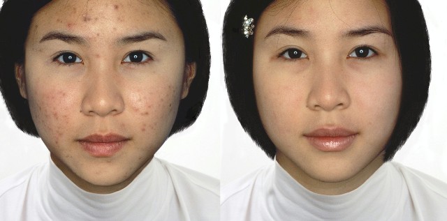 Pigment behandeling / Zo Medical by Dr. Zein Obagi