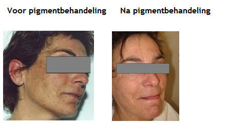 Pigment - melasme