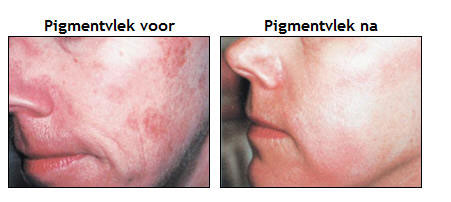 Pigment - melasme